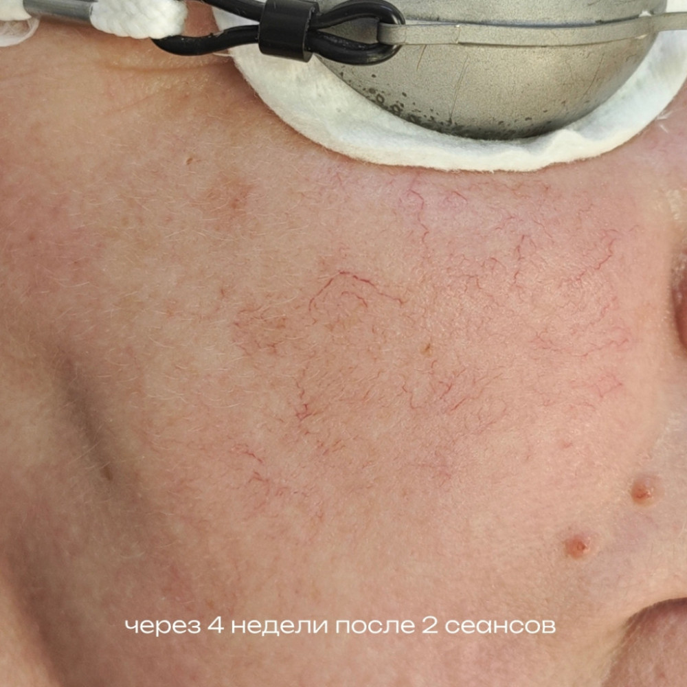 Фотолечение сосудов До-После после