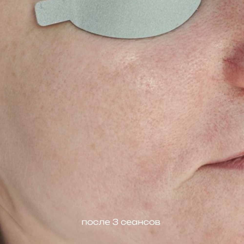Фотоомоложение До-После после