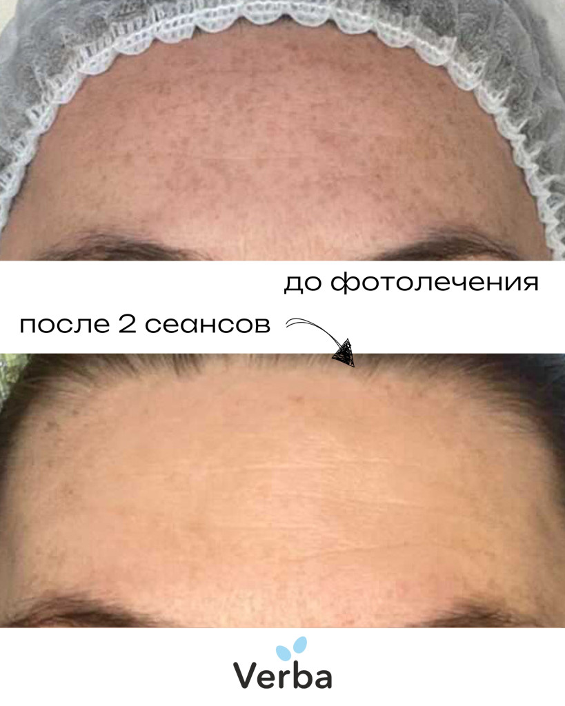 Фотоомоложение в Verba фото до-после