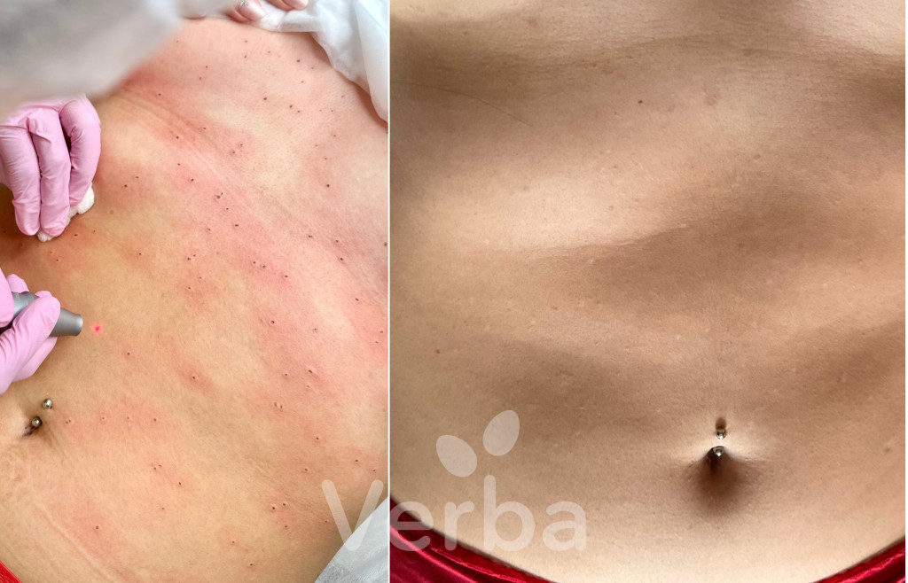 Лазерное удаление новообразований До-После