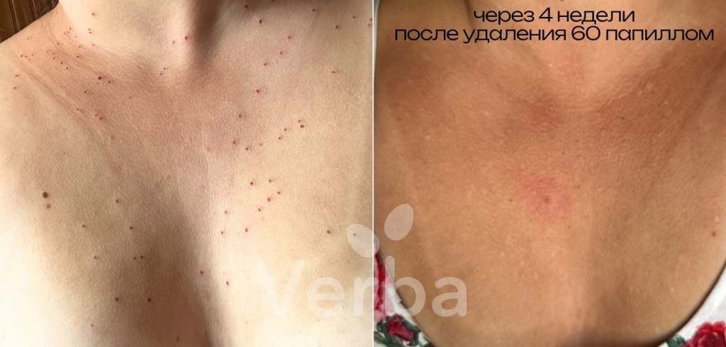 Лазерное удаление папиллом До-После Лазерное удаление папиллом До-После