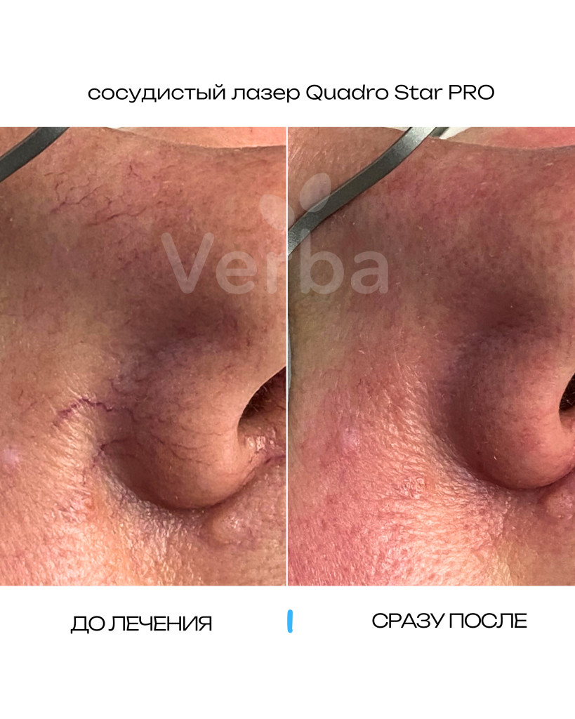 QuadroStarPRO до-после 02.jpg QuadroStarPRO до-после 02.jpg