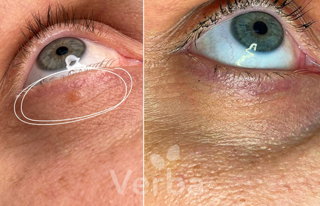 Лазерное удаление новообразований на веке До-После