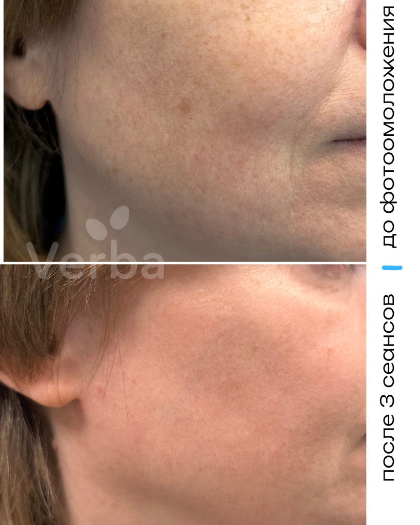 Фотоомоложение в Verba фото до-после Фотоомоложение в Verba фото до-после
