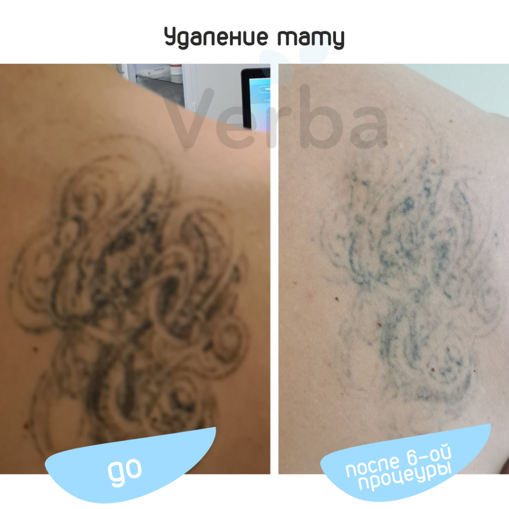 Лазерное удаление татуировки Лазерное удаление татуировки