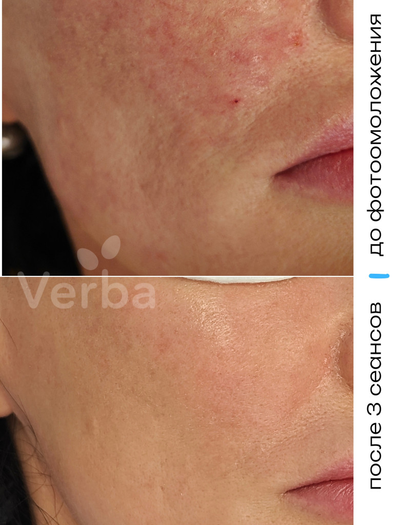 Фотолечение в Verba фото до-после Фотолечение в Verba фото до-после
