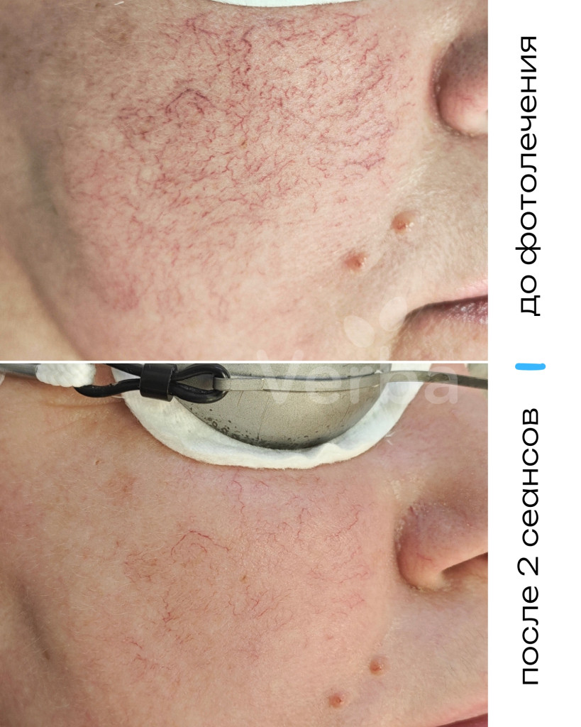 Фотолечение в Verba фото до-после Фотолечение в Verba фото до-после